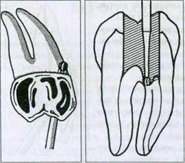 пломбирование зубов перфорация